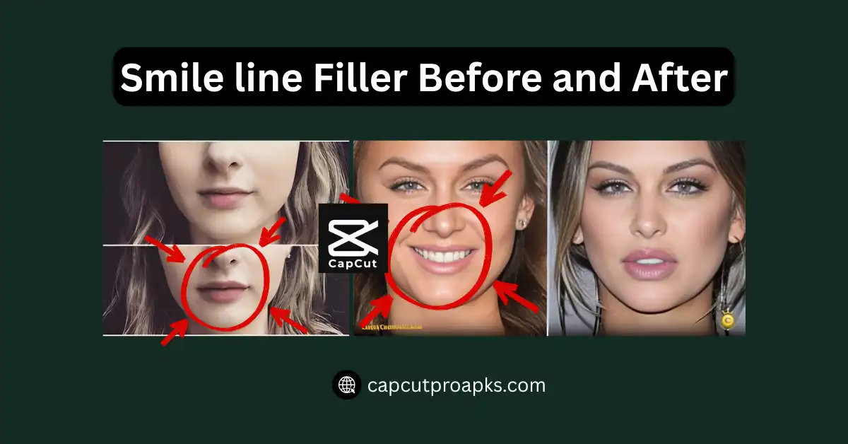 Smile Line Filler Before and After - Stunning Results You’ll Love in 2026! 1 Smile line Filler Before and After